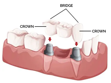 Crowns & Bridges